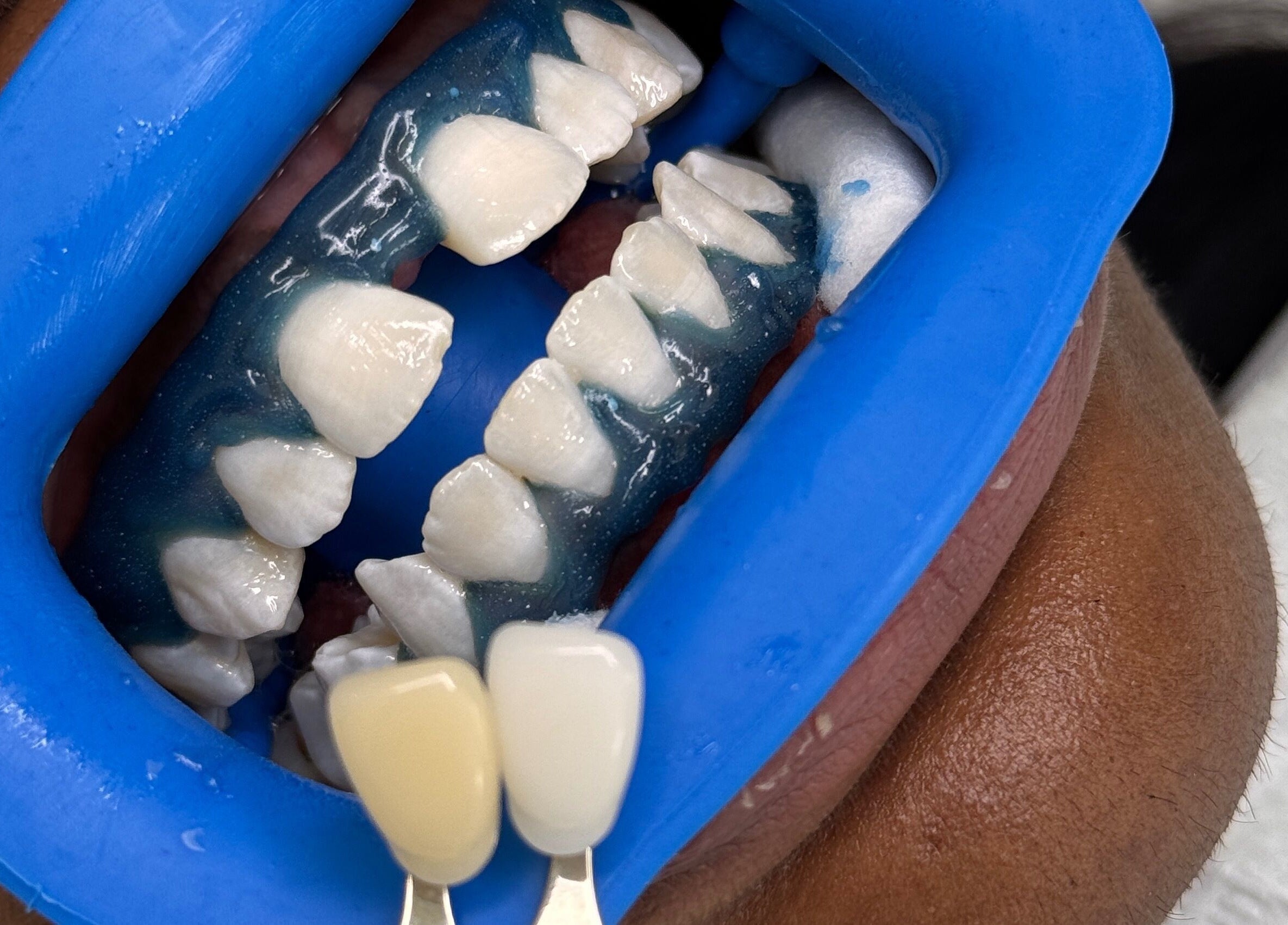 Teeth whitening preparation at Whitesbylia in London, England, GB showcasing dental treatment process.