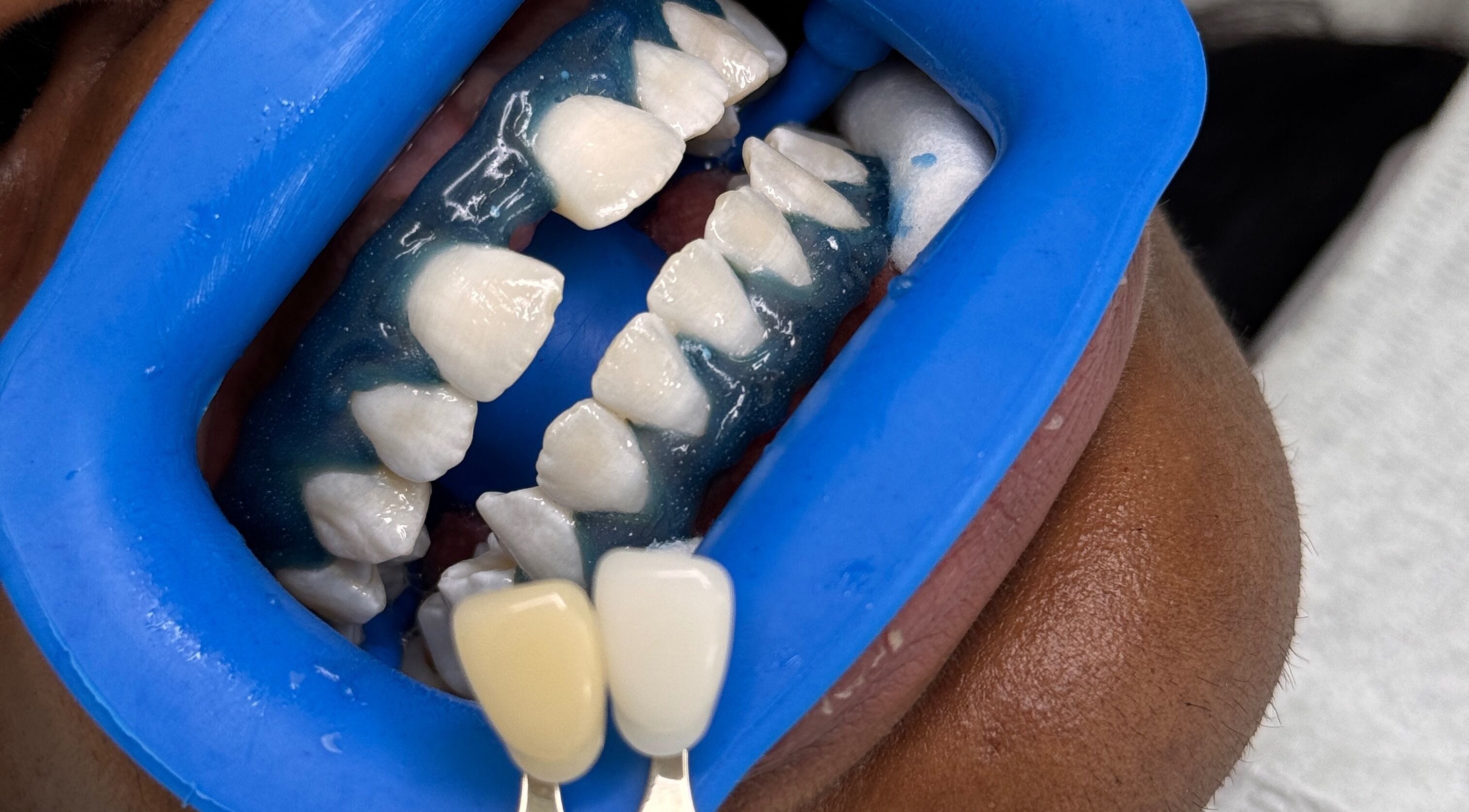 Teeth whitening preparation at Whitesbylia in London, England, GB showcasing dental treatment process.