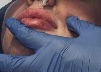 Close-up of lip enhancement procedure at Candace Lawrence beauty Co., Bath, Ontario, CA.
