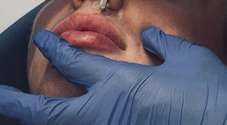 Close-up of lip enhancement procedure at Candace Lawrence beauty Co., Bath, Ontario, CA.