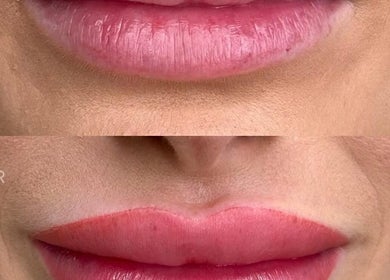 Before and after lip enhancement at JKANSHAY AESTHETIC CLINIC, LONDON, England, GB.