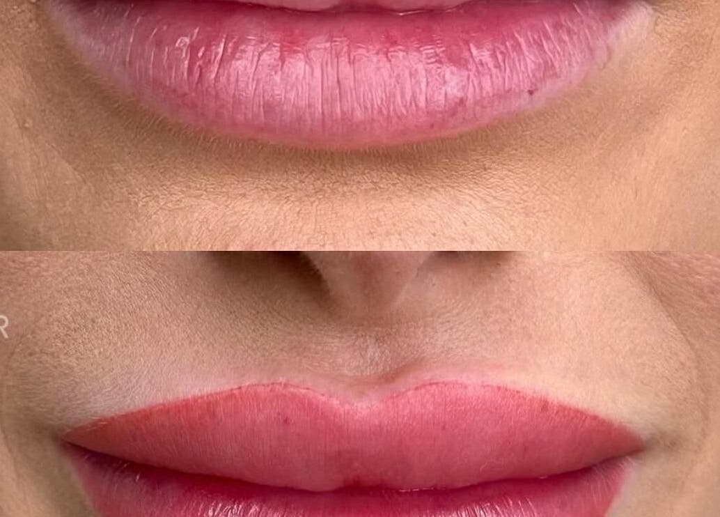 Before and after lip enhancement at JKANSHAY AESTHETIC CLINIC, LONDON, England, GB.