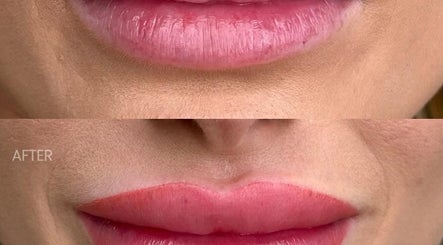 Before and after lip enhancement at JKANSHAY AESTHETIC CLINIC, LONDON, England, GB.