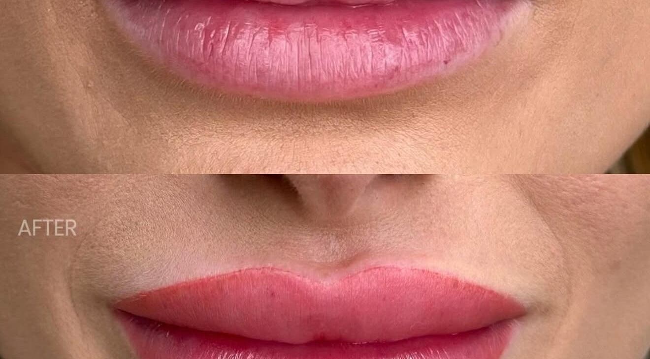Before and after lip enhancement at JKANSHAY AESTHETIC CLINIC, LONDON, England, GB.