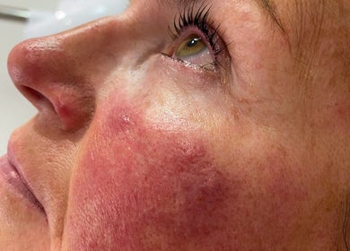 Close-up of facial skin after treatment at Amaze Beauty, Coleraine, Northern Ireland, GB.