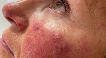 Close-up of facial skin after treatment at Amaze Beauty, Coleraine, Northern Ireland, GB.