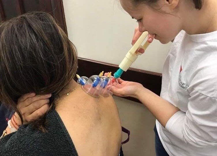 Cupping therapy session at Astbury Acutherapy in Congleton, England, GB, showcasing expert wellness care.