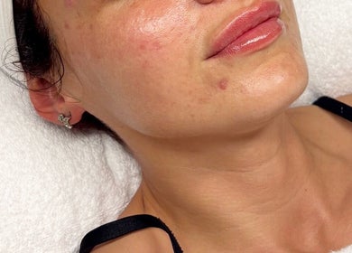 Close-up facial treatment at Opulence Skin Aesthetics, Whiston, England, GB, showcasing glowing skin.