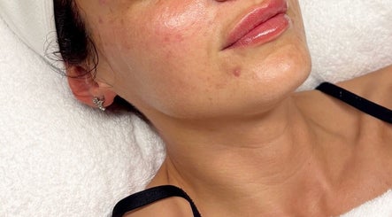 Close-up facial treatment at Opulence Skin Aesthetics, Whiston, England, GB, showcasing glowing skin.