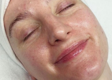 Close-up of a relaxed face with glowing skin at Opulence Skin Aesthetics, Whiston, England, GB.