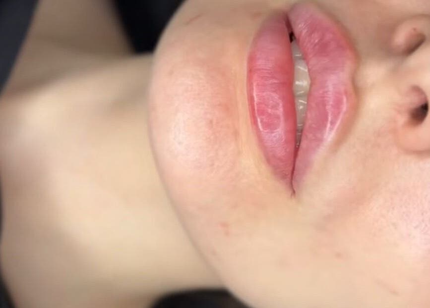 Close-up of treated lips at VIVA Medical in Dublin, County Dublin, IE, showcasing beauty enhancement.