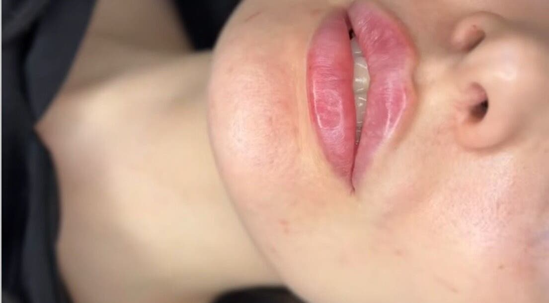 Close-up of treated lips at VIVA Medical in Dublin, County Dublin, IE, showcasing beauty enhancement.