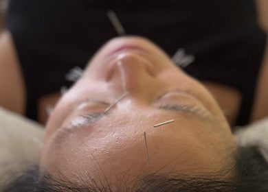 Acupuncture session at Iyengar Holistic in Willemstad, CW, highlighting relaxation and wellness focus.