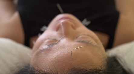 Acupuncture session at Iyengar Holistic in Willemstad, CW, highlighting relaxation and wellness focus.
