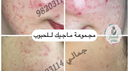 نتائج علاج حب الشباب في Jamali Facial، مسقط السيب‎، محافظة مسقط، OM.