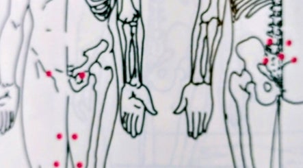 Illustration des points Hijama à Charmig Hijama & Relaxation, Ottawa, Ontario, CA.