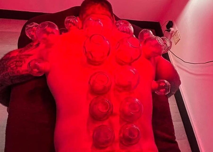 Cupping therapy session at Revive Massage Therapy in Guernsey, Vale, GG with red ambient lighting.