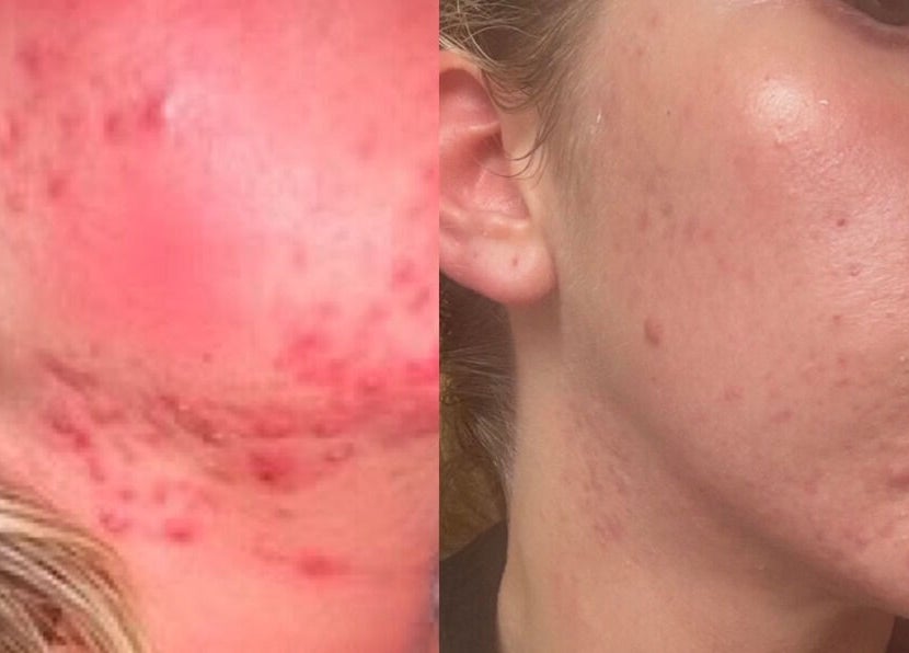 Before and after acne treatment at Emily - Skin Rest Results, Sheffield, England, GB.