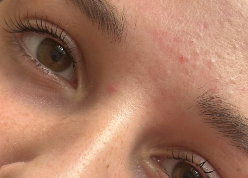 Close-up of a clear, glowing skin at The Beauty Vault in Tandragee, Northern Ireland, GB.