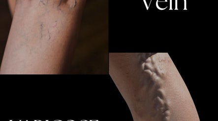 Varicose vein treatment options at Sonus Per Aqua Med Spa in Kingston 10, St. Andrew Parish, JM.