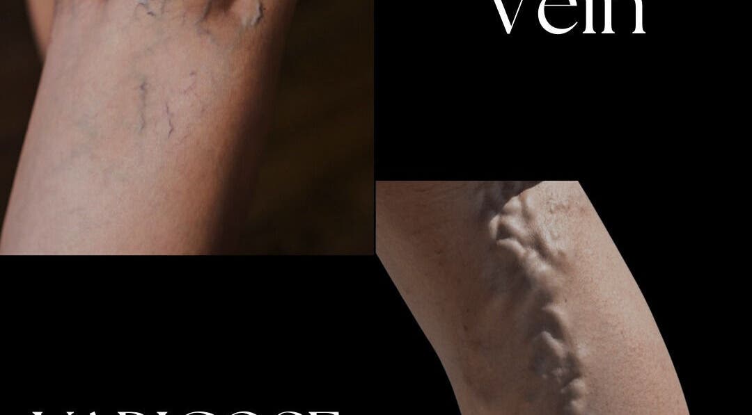 Varicose vein treatment options at Sonus Per Aqua Med Spa in Kingston 10, St. Andrew Parish, JM.