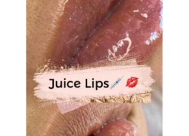 Lujosos labios tratados en D'Studio✨, El Médano, Canarias, ES, mostrando resultados brillantes y voluminosos.