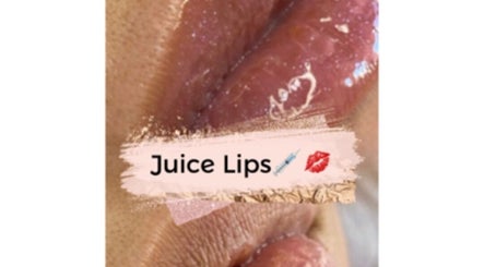 Lujosos labios tratados en D'Studio✨, El Médano, Canarias, ES, mostrando resultados brillantes y voluminosos.