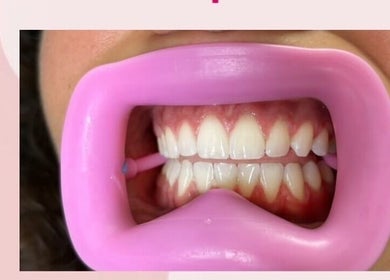 Blanchiment dentaire professionnel à Lombardi Beauty, Honnelles, Région Wallonne, BE, avec un protège-bouche rose.