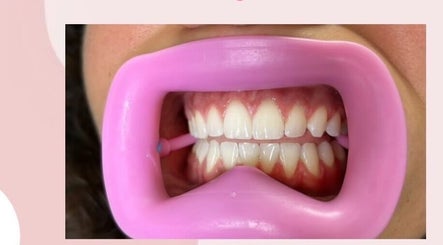 Blanchiment dentaire professionnel à Lombardi Beauty, Honnelles, Région Wallonne, BE, avec un protège-bouche rose.