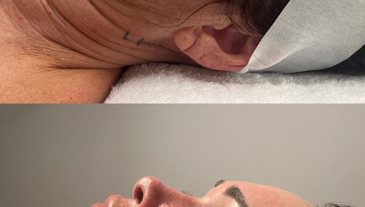 Before and after facial treatment at The Skin Room Brisbane, Bongaree, Queensland, AU showing visible transformation.