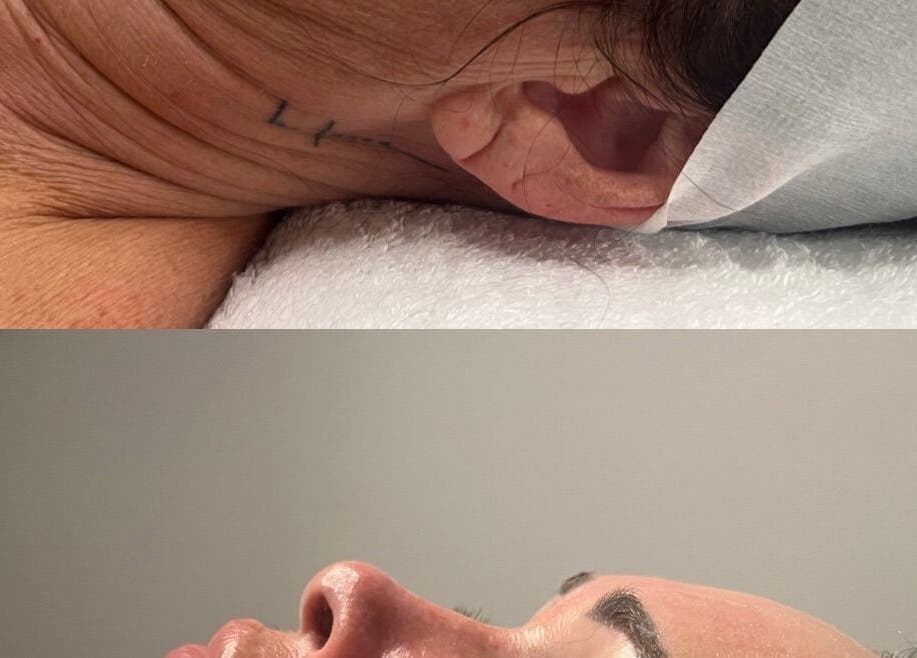 Before and after facial treatment at The Skin Room Brisbane, Bongaree, Queensland, AU showing visible transformation.