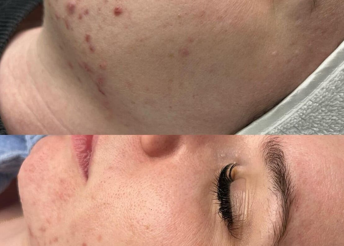 Before and after skin treatment at The Skin Room Brisbane, Bongaree, Queensland, AU showing improved complexion.