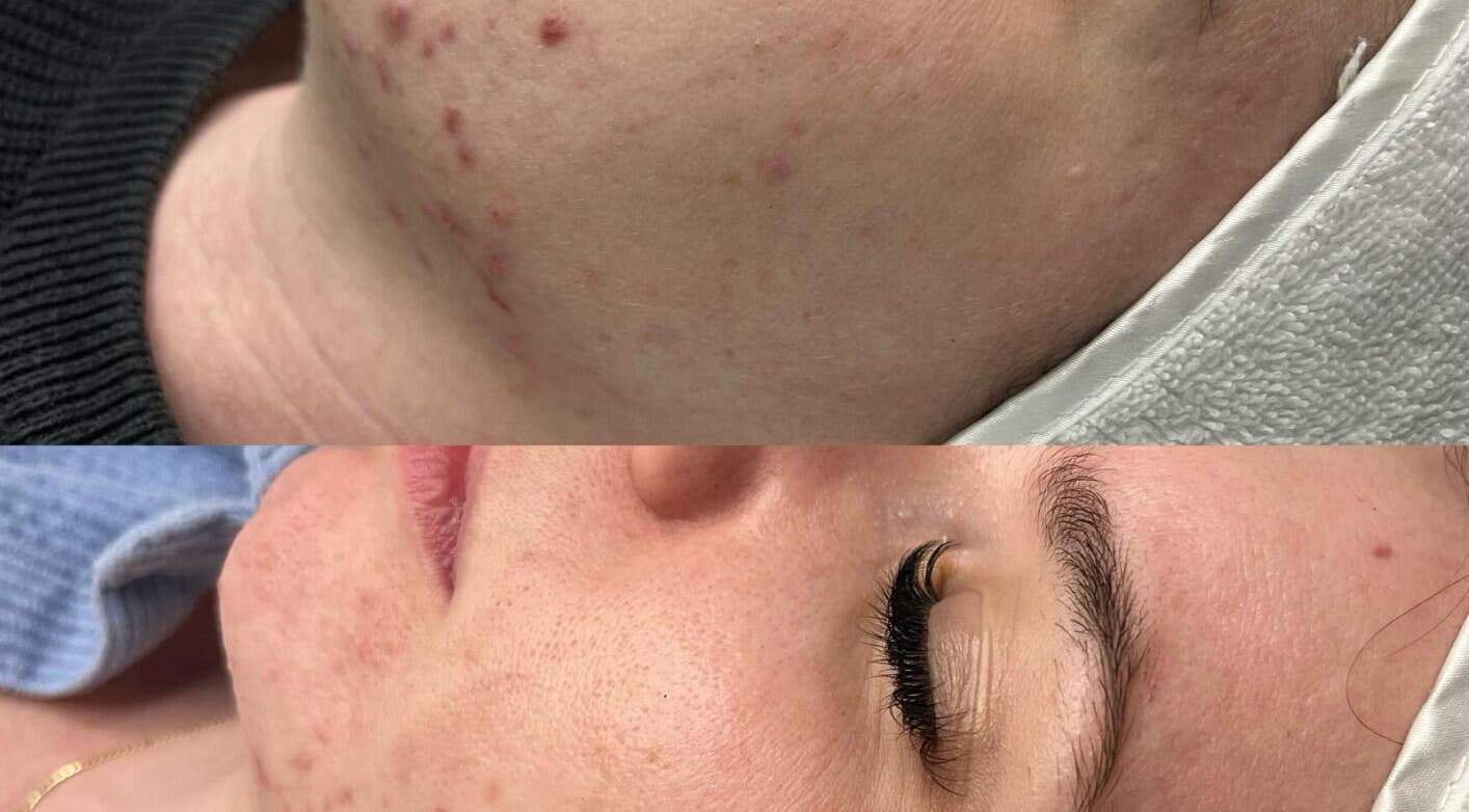Before and after skin treatment at The Skin Room Brisbane, Bongaree, Queensland, AU showing improved complexion.