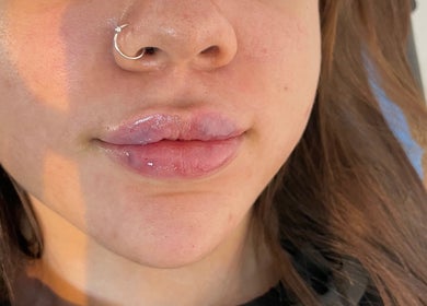 Freshly enhanced lips at Shak Smith Aesthetics, Bridgetown, Saint Michael, BB, showcasing glossy, natural results.