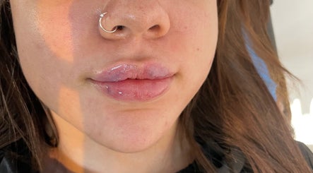 Freshly enhanced lips at Shak Smith Aesthetics, Bridgetown, Saint Michael, BB, showcasing glossy, natural results.