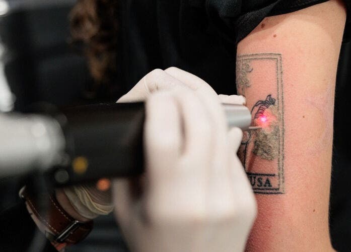 Laser tattoo removal in progress at Emma McCulloch Tattoo Removal & Aesthetics, Everton Park, Queensland, AU.