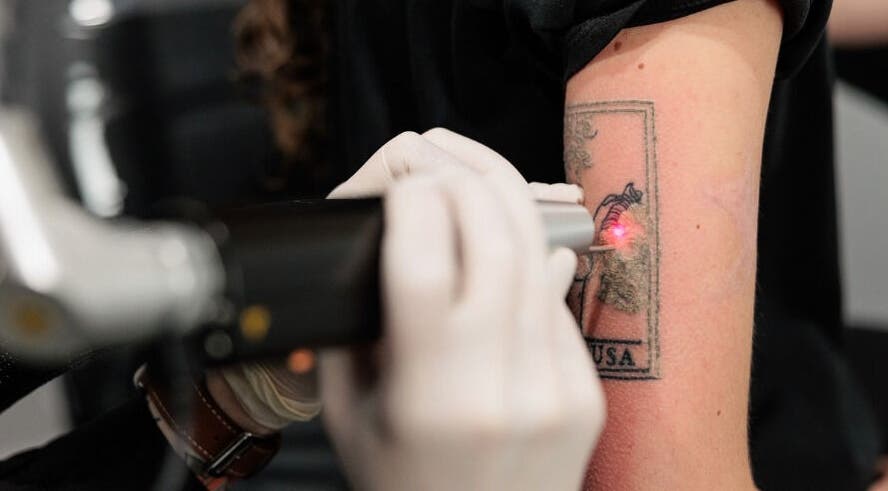 Laser tattoo removal in progress at Emma McCulloch Tattoo Removal & Aesthetics, Everton Park, Queensland, AU.