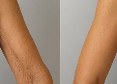 Przed i po zabiegu na ramionach w Mano Estetic Medycyna Estetyczna, Wrocław, Województwo Dolnośląskie, PL.