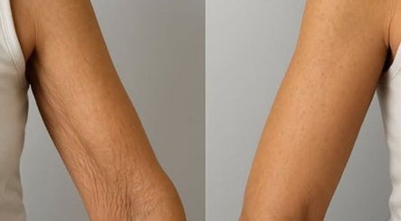 Przed i po zabiegu na ramionach w Mano Estetic Medycyna Estetyczna, Wrocław, Województwo Dolnośląskie, PL.
