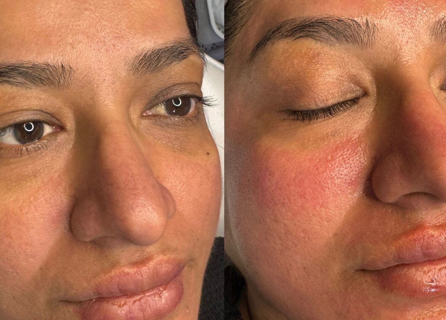 Facial rejuvenation results at DMD Aesthetics, Eccles, England, GB showcasing smooth and glowing skin.