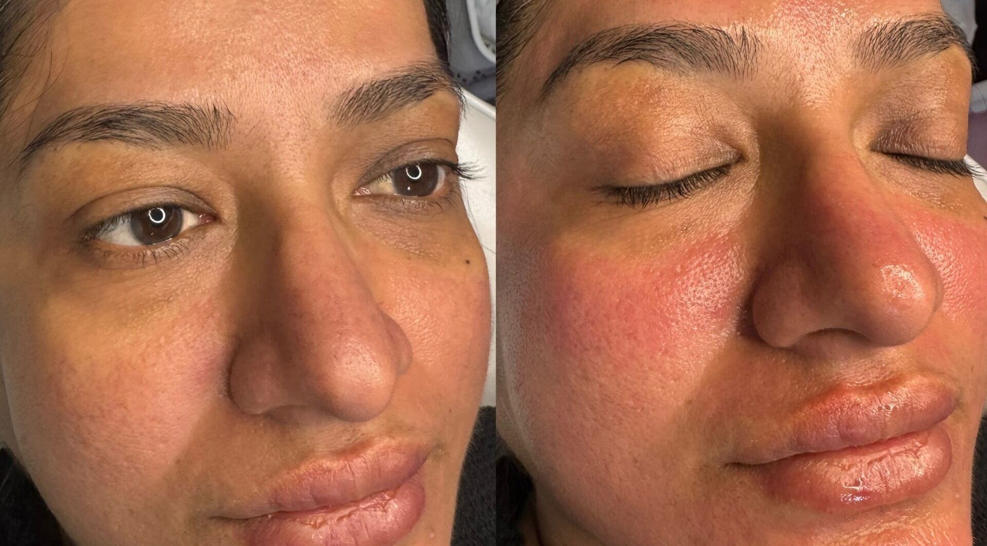 Facial rejuvenation results at DMD Aesthetics, Eccles, England, GB showcasing smooth and glowing skin.