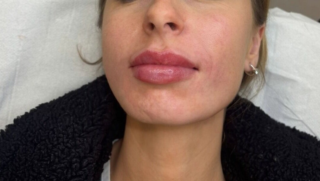 Close-up of enhanced lips at IV Aesthetics in Dublin, IE, showcasing expert cosmetic treatment.