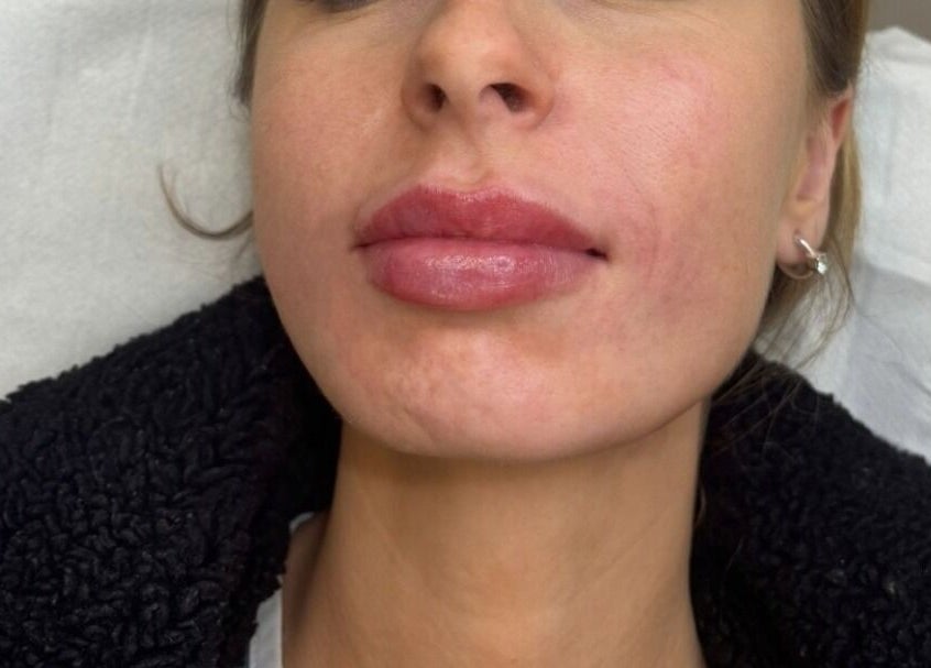 Close-up of enhanced lips at IV Aesthetics in Dublin, IE, showcasing expert cosmetic treatment.