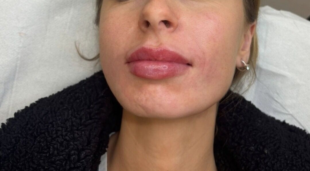 Close-up of enhanced lips at IV Aesthetics in Dublin, IE, showcasing expert cosmetic treatment.
