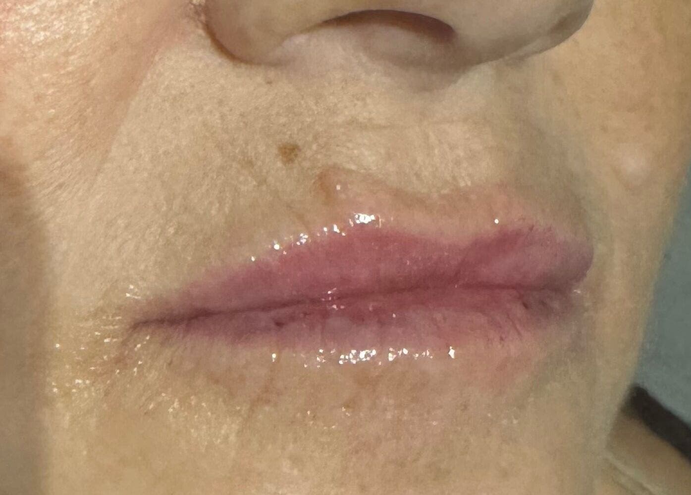 Smooth lip enhancement results at MavenAesthetics, London, England, GB