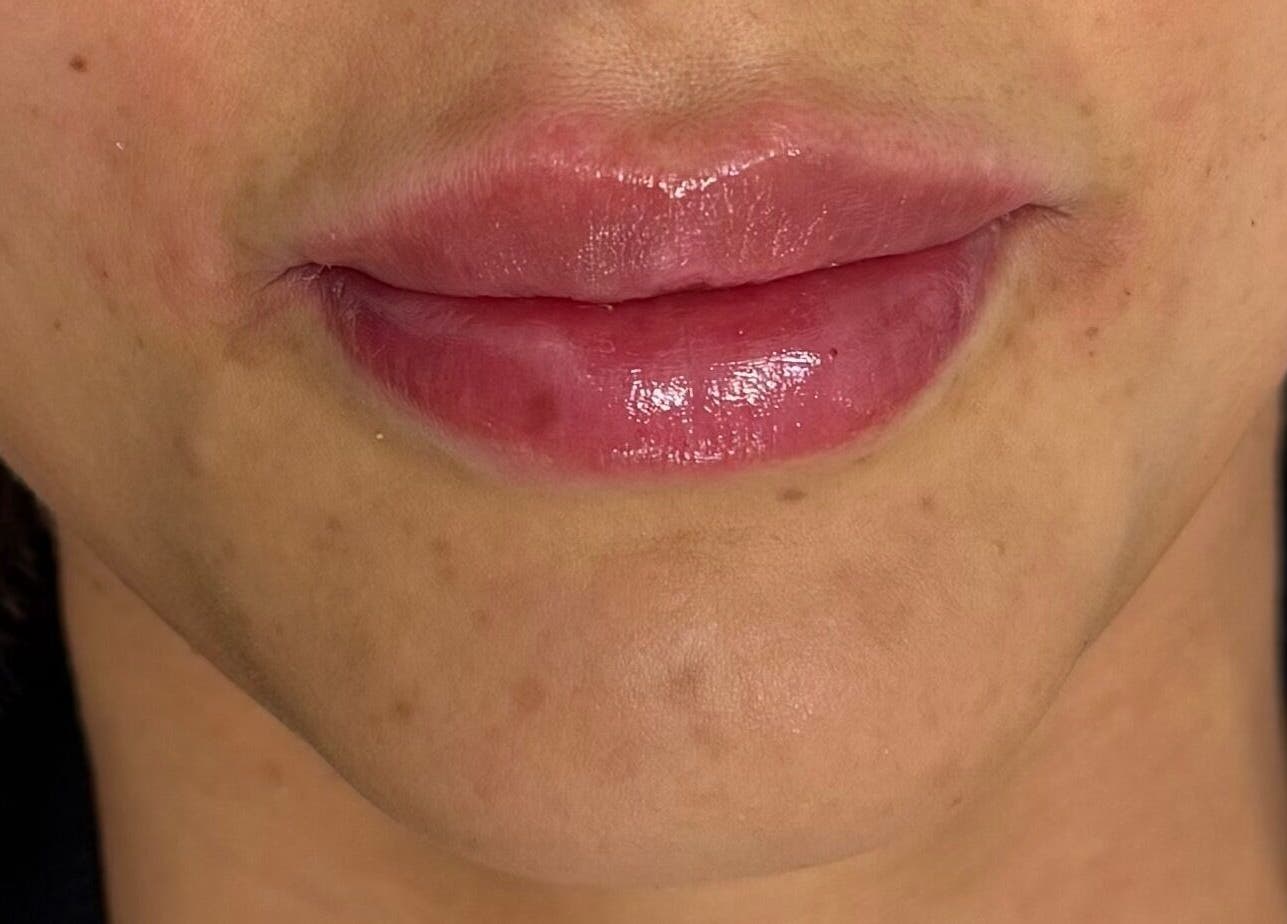 Close-up of glossy lips after treatment at MavenAesthetics in London, England, GB.