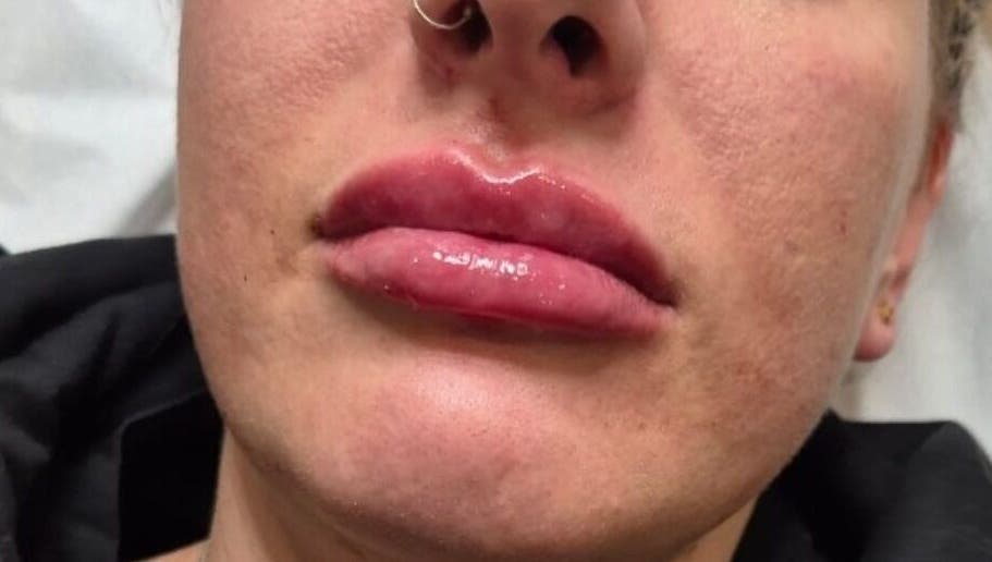 Enhanced lips at NA aesthetics, Milford Haven, Wales, GB showcase expert beauty treatment.