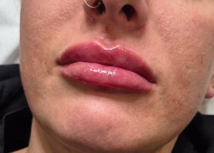 Enhanced lips at NA aesthetics, Milford Haven, Wales, GB showcase expert beauty treatment.