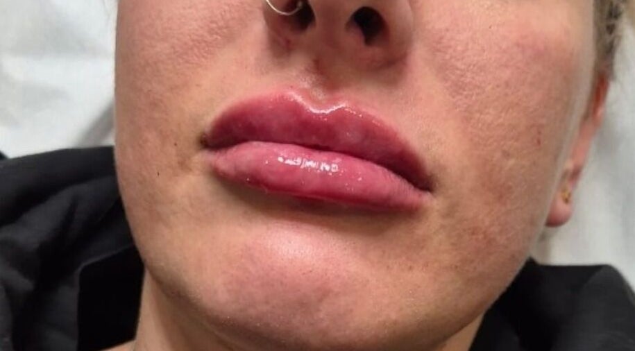 Enhanced lips at NA aesthetics, Milford Haven, Wales, GB showcase expert beauty treatment.