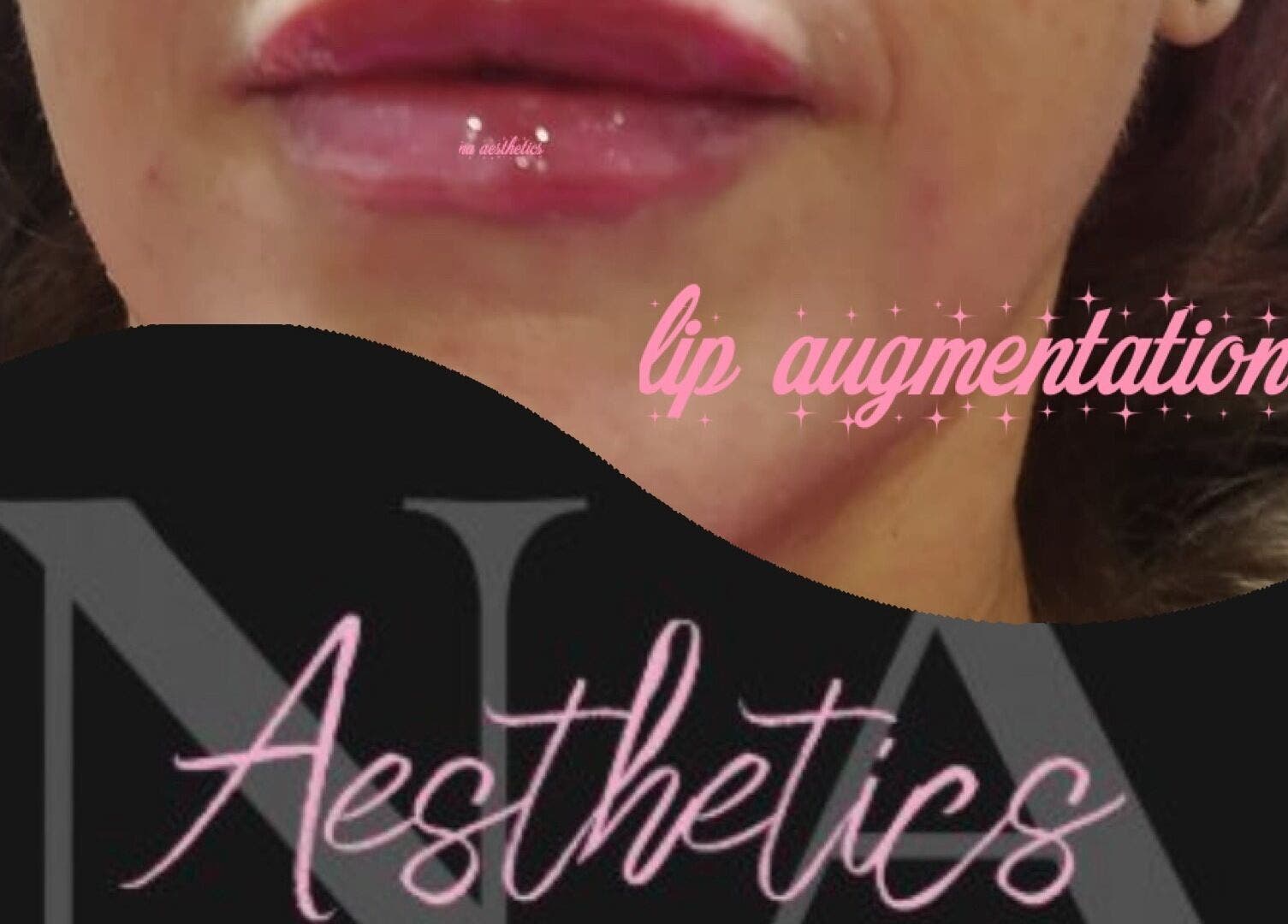 Close-up of lip augmentation at NA aesthetics in Milford Haven, Wales, GB.